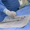 Pierwszy w Polsce jednoczesny przeszczep serca i wątroby